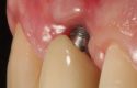 Diplomado en Cirugía Plástica Implantológica y Periodontal